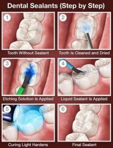 Dental Sealants Step by Step