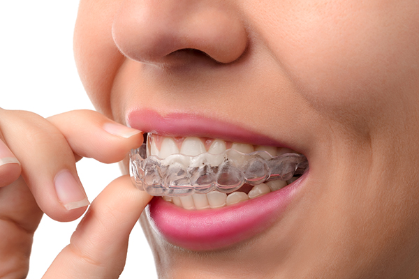 Orthodontics | Invisalign Braces