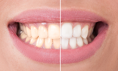 Before-After Teeth Whitening