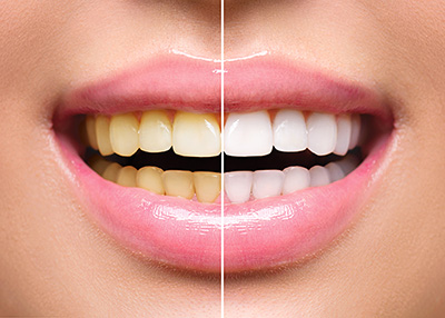 Cosmetic Procedure - Teeth Whitening